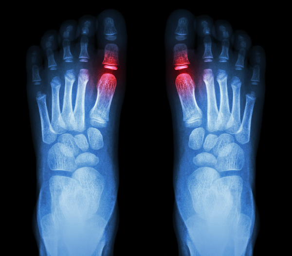 Big Toe Arthritis Foot Care Products FootDocStore