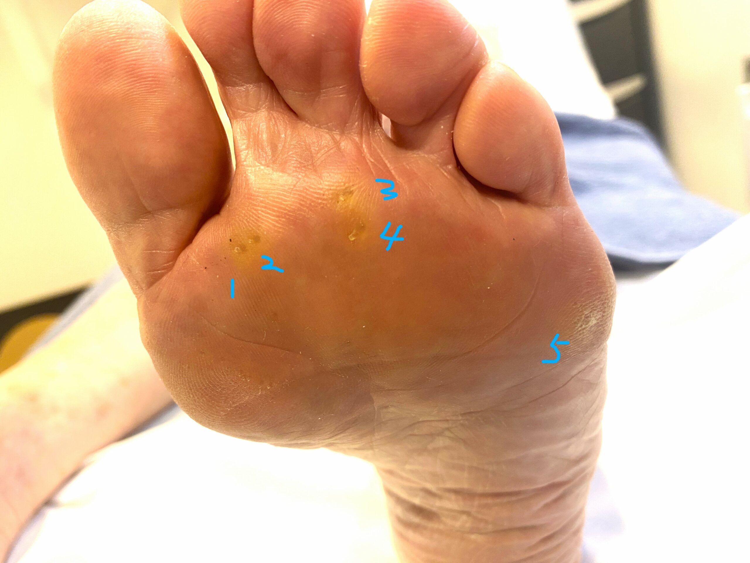 발바닥 티눈 (IPK, intractable plantar keratoma) 제거 시드니 좋은 발병원