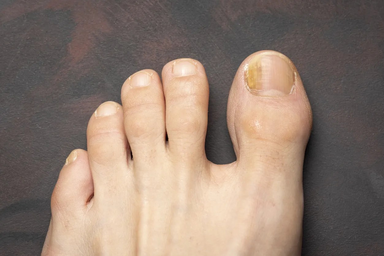 Why Are My Toenails Orange After Removing Polish at Lena Lira blog