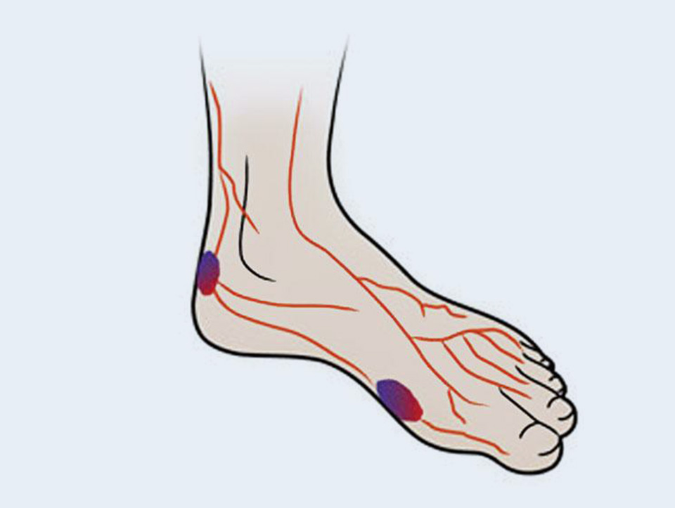 Diabetic Foot Footlogics Orthotics