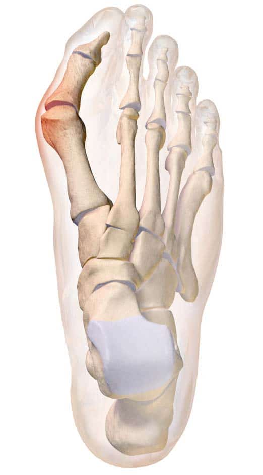 Bunion / Hallux Valgus Care and Treatment Dr Keith