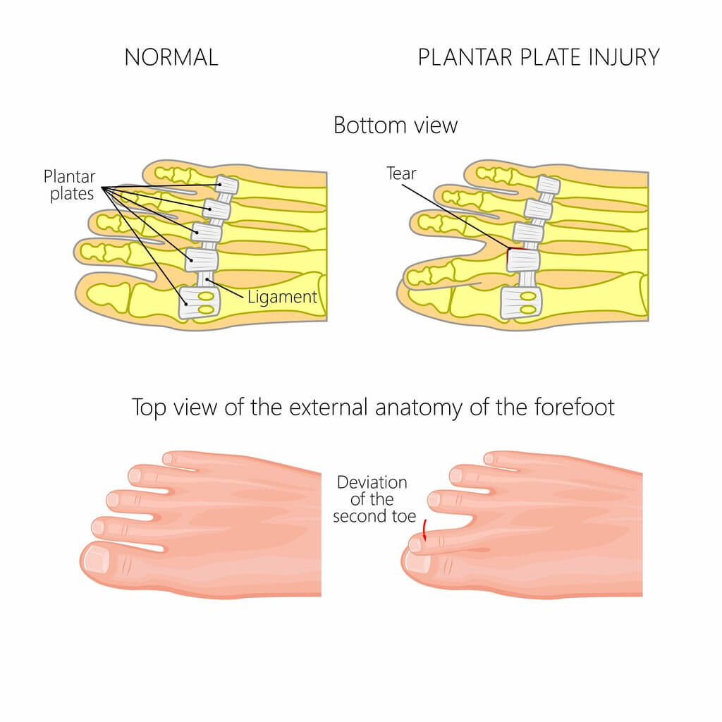 Plantar Plate Tear Farnsworth Orthopedic Physical Therapy