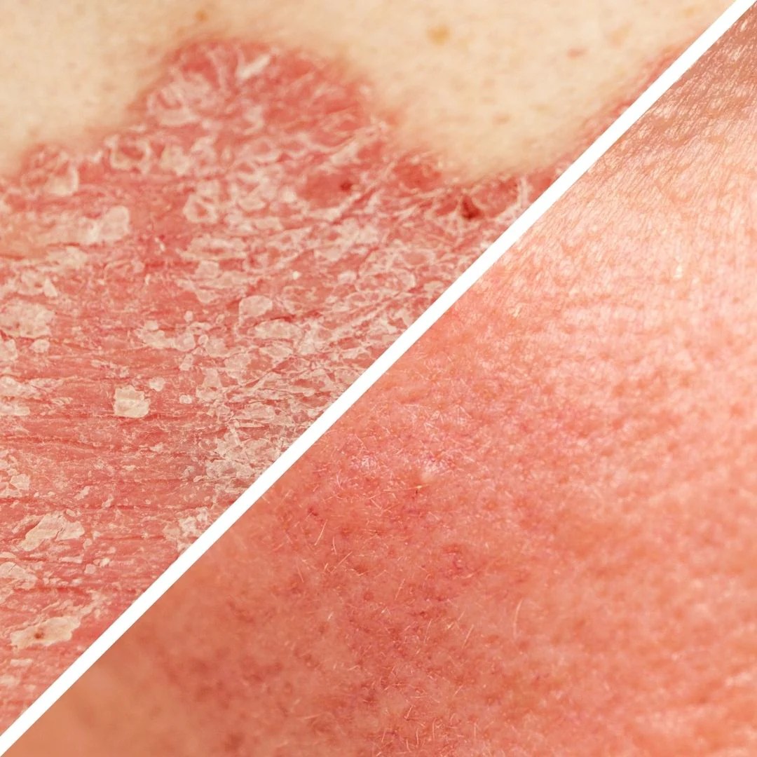 How are Rosacea and Psoriasis Different? Forces of Nature Medicine