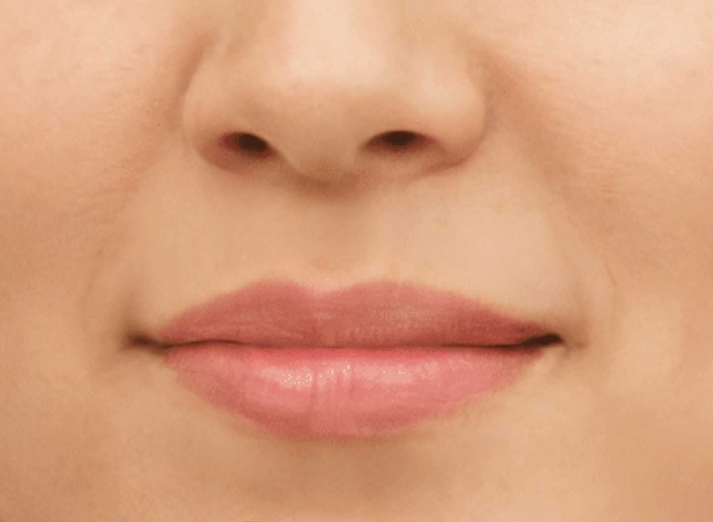 Fordyce Gel See Before/After pictures of Fordyce spots treated at home