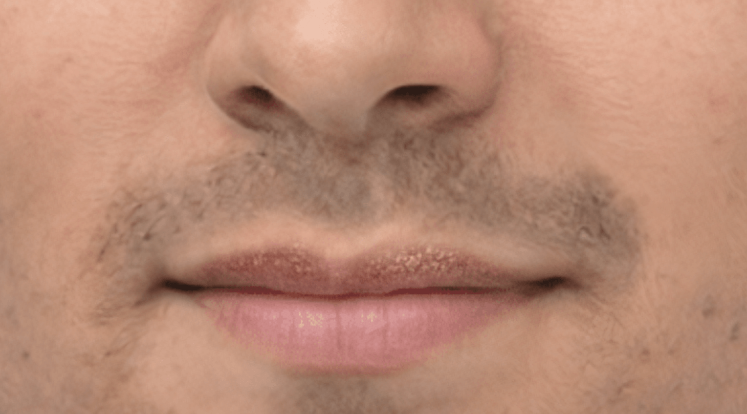 Fordyce Gel See Before/After pictures of Fordyce spots treated at home