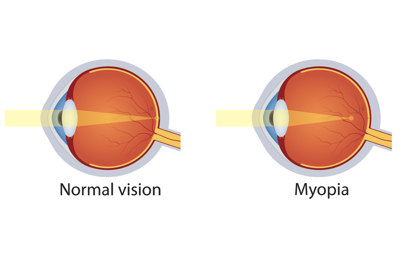 How to Choose a Myopia Control Treatment Foresee Eyecare