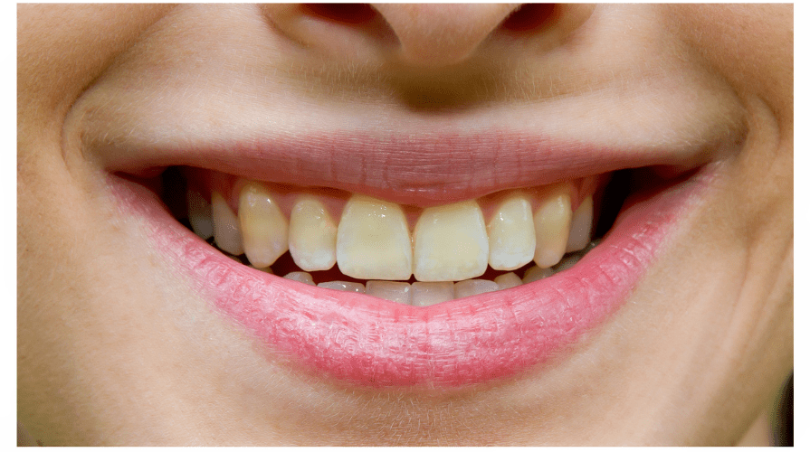 Tooth erosion Forest & Ray Dentists, Orthodontists, Implant Surgeons