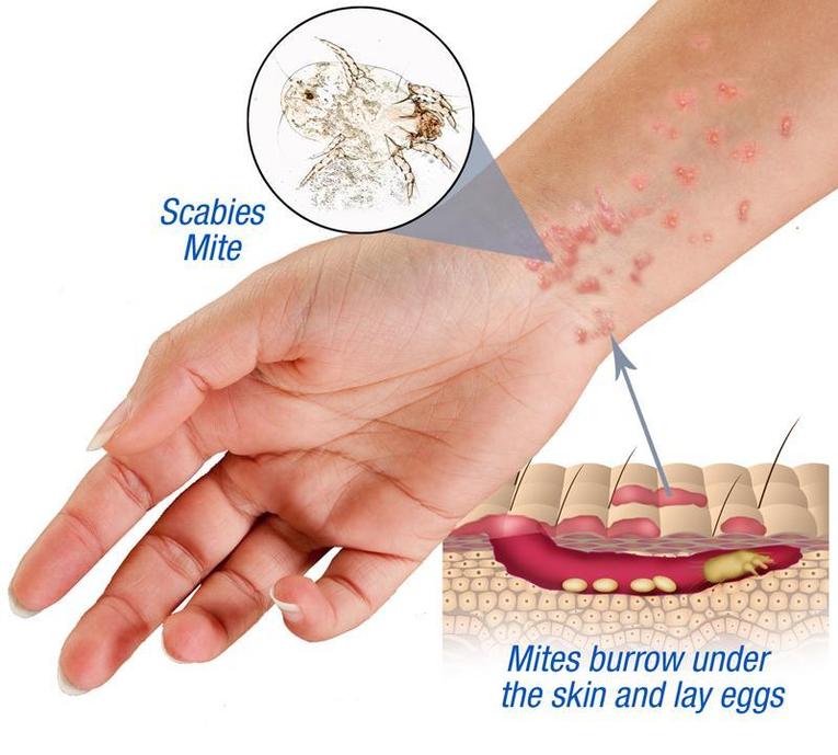 How to Kill Mites with Ozone Forever Ozone