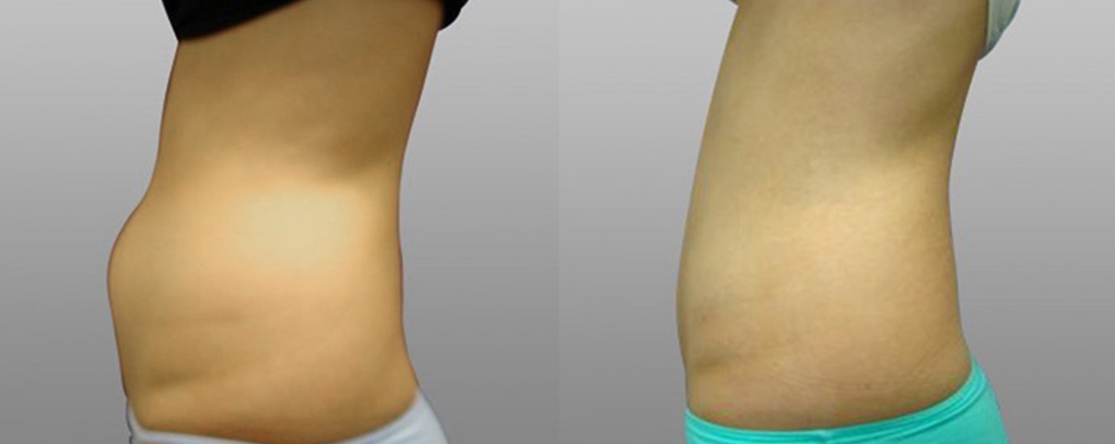 Liposculpture Sydney Liposuction Lipoplasty Dr Norris