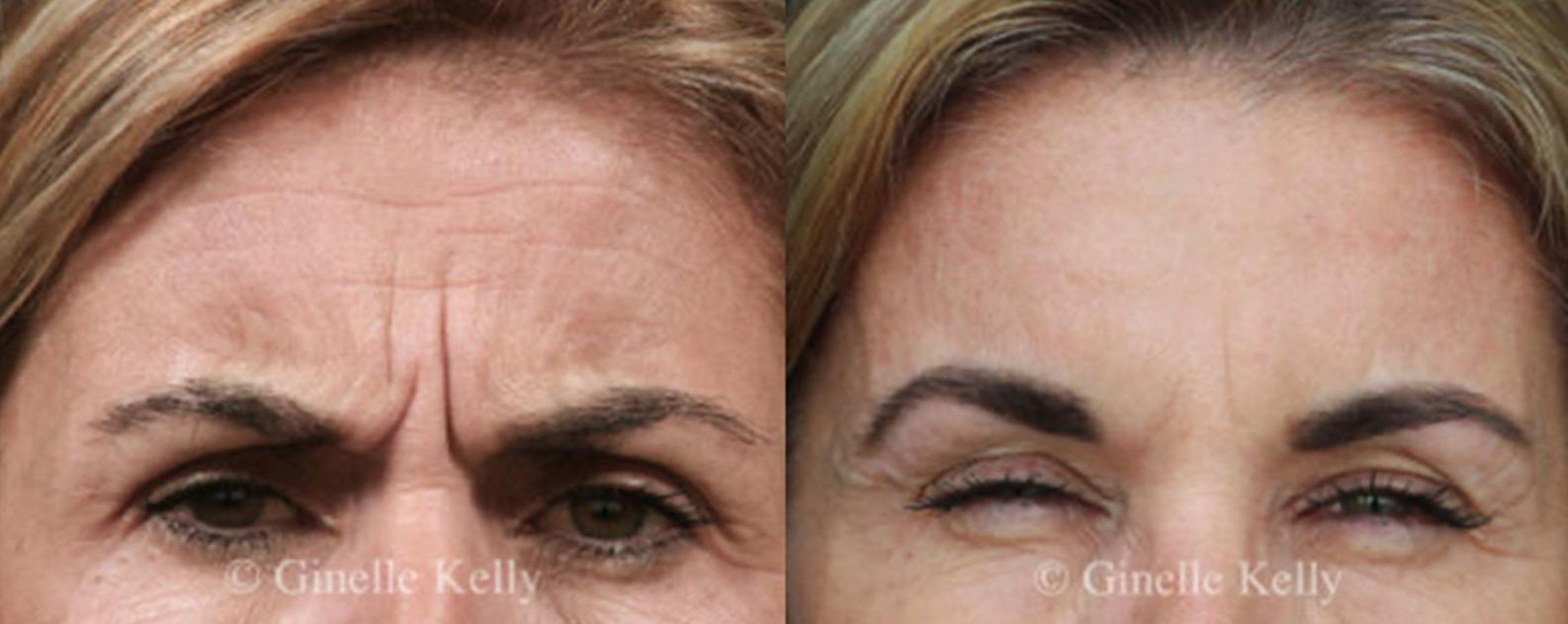 AntiWrinkle Injections Sydney Form & Face Medispa