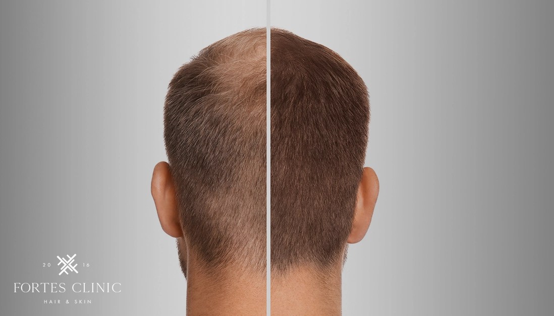 A Guide To Topical Finasteride Fortes Clinic