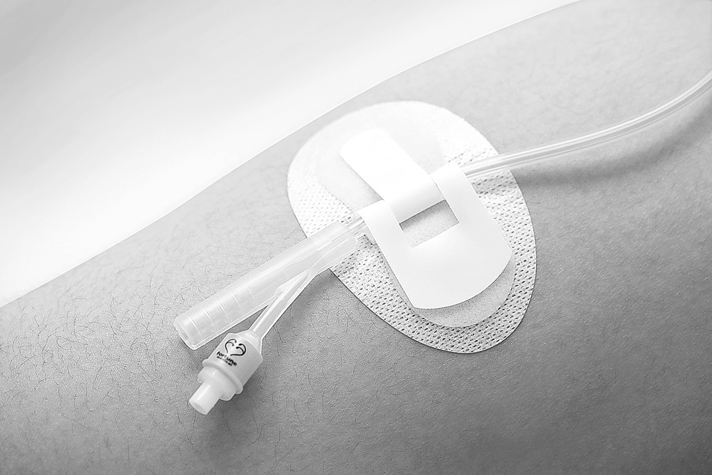 Patented Integrated Balloon Design's Foley Catheter With Fixpad