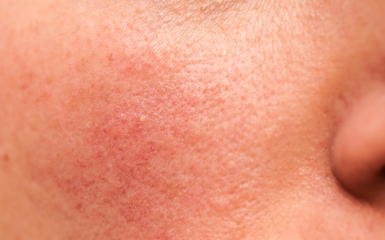 Don’t Mistake These Skin Conditions for Acne Faculty of Medicine