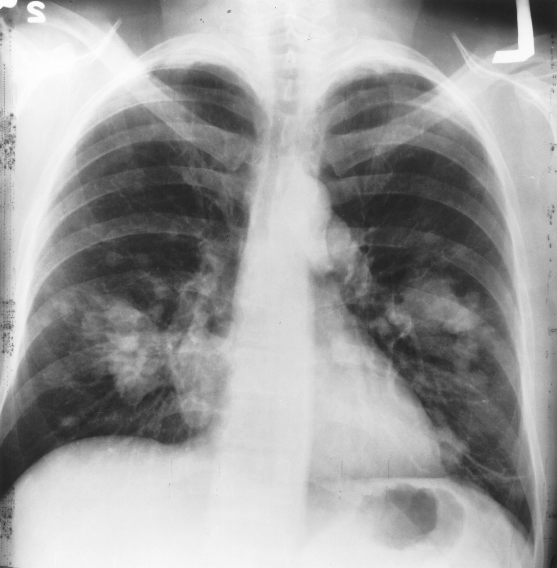 Does Lung Cancer Show on XRay? Faculty of Medicine