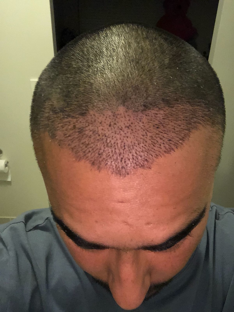 Traction Alopecia Timeline MedLinks Hair Transplants Traction Alopecia Timeline MedLinks Hair Transplants