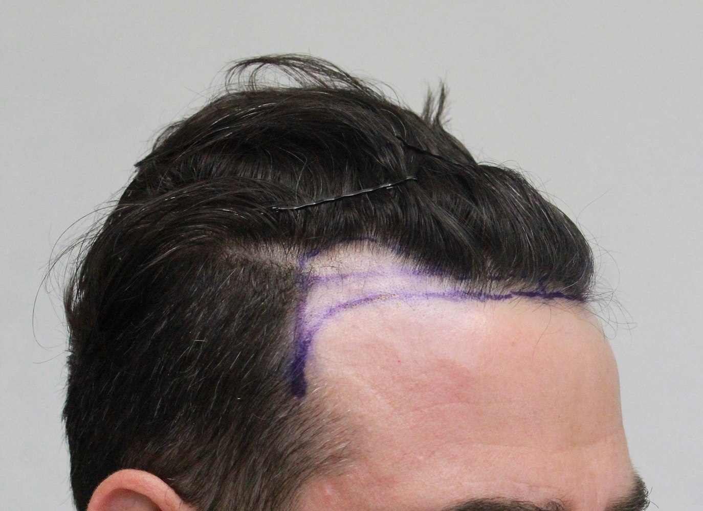 Rahal FUE Norwood 2 Hair Transplant HairSite Hair Restoration Forum