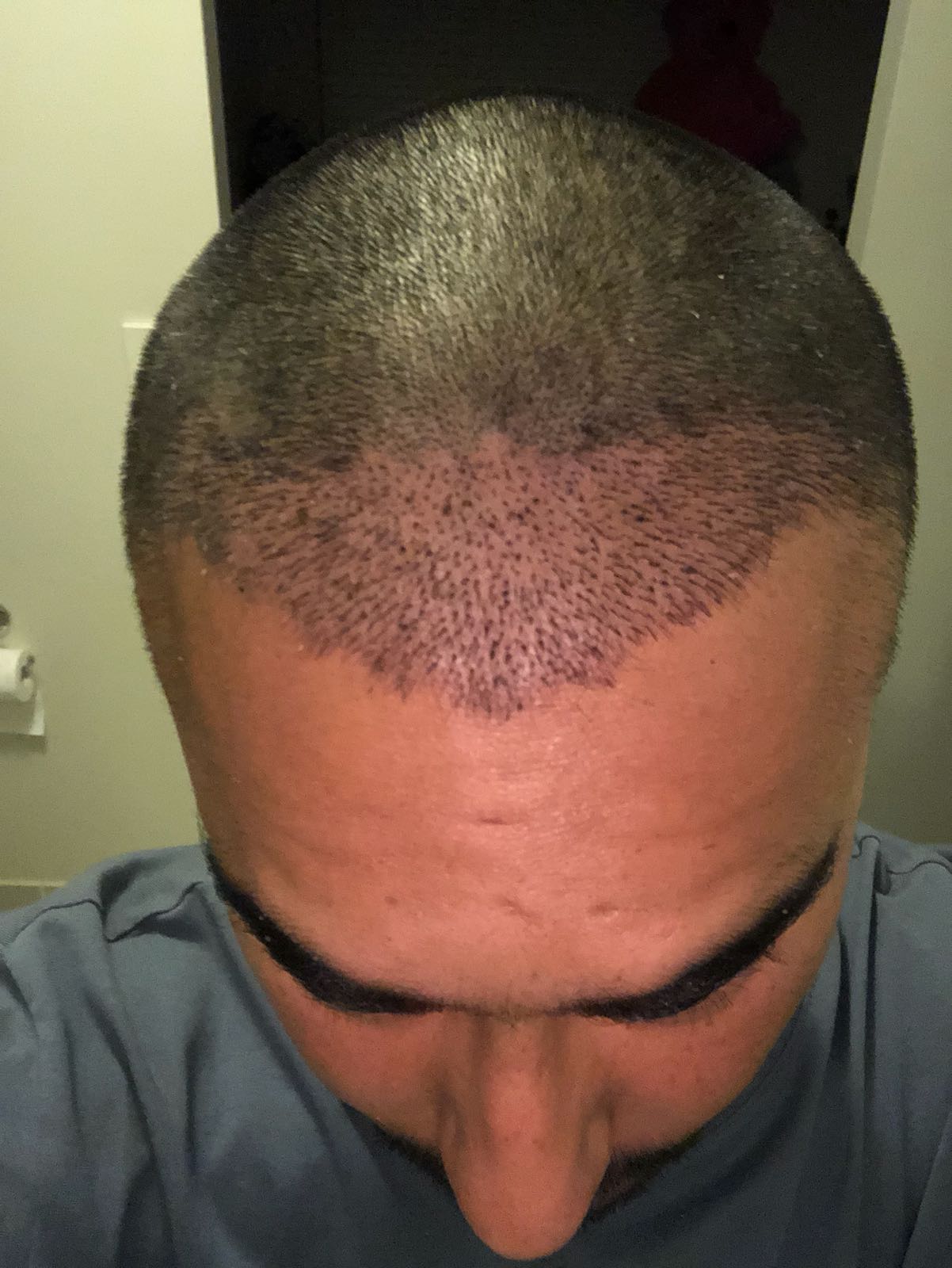 Traction Alopecia Timeline MedLinks Hair Transplants