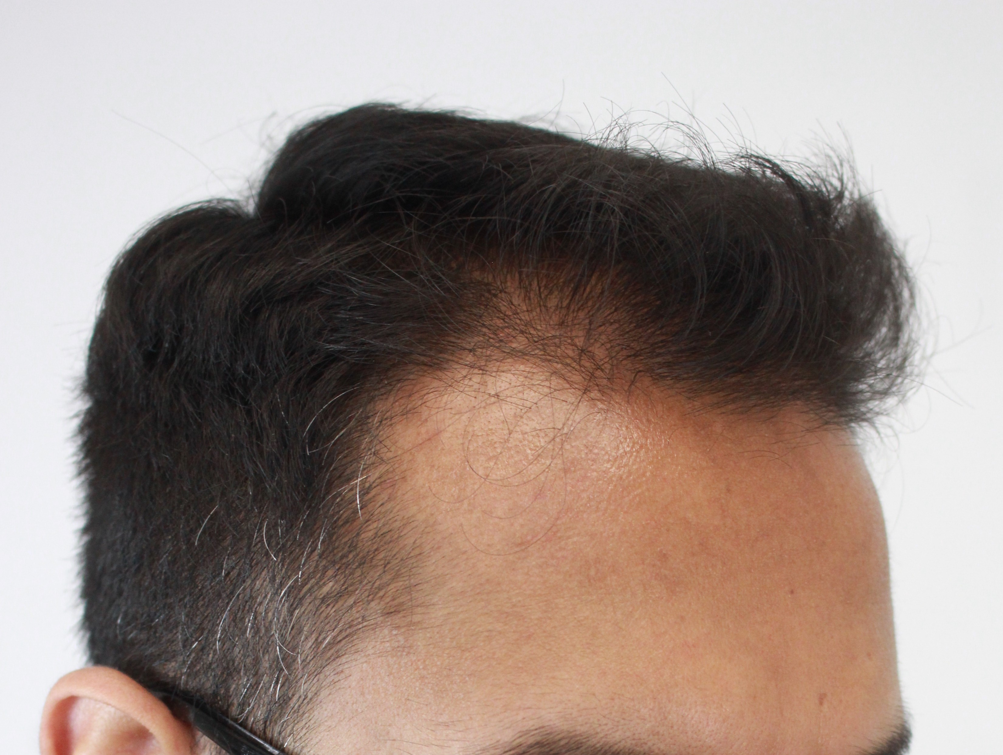 Rahal FUT Norwood 4 Hair Transplant HairSite Hair Restoration Forum