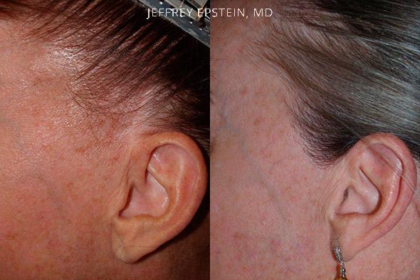 Dr. Epstein women facelift scar repair, 500 grafts strip Women Hair