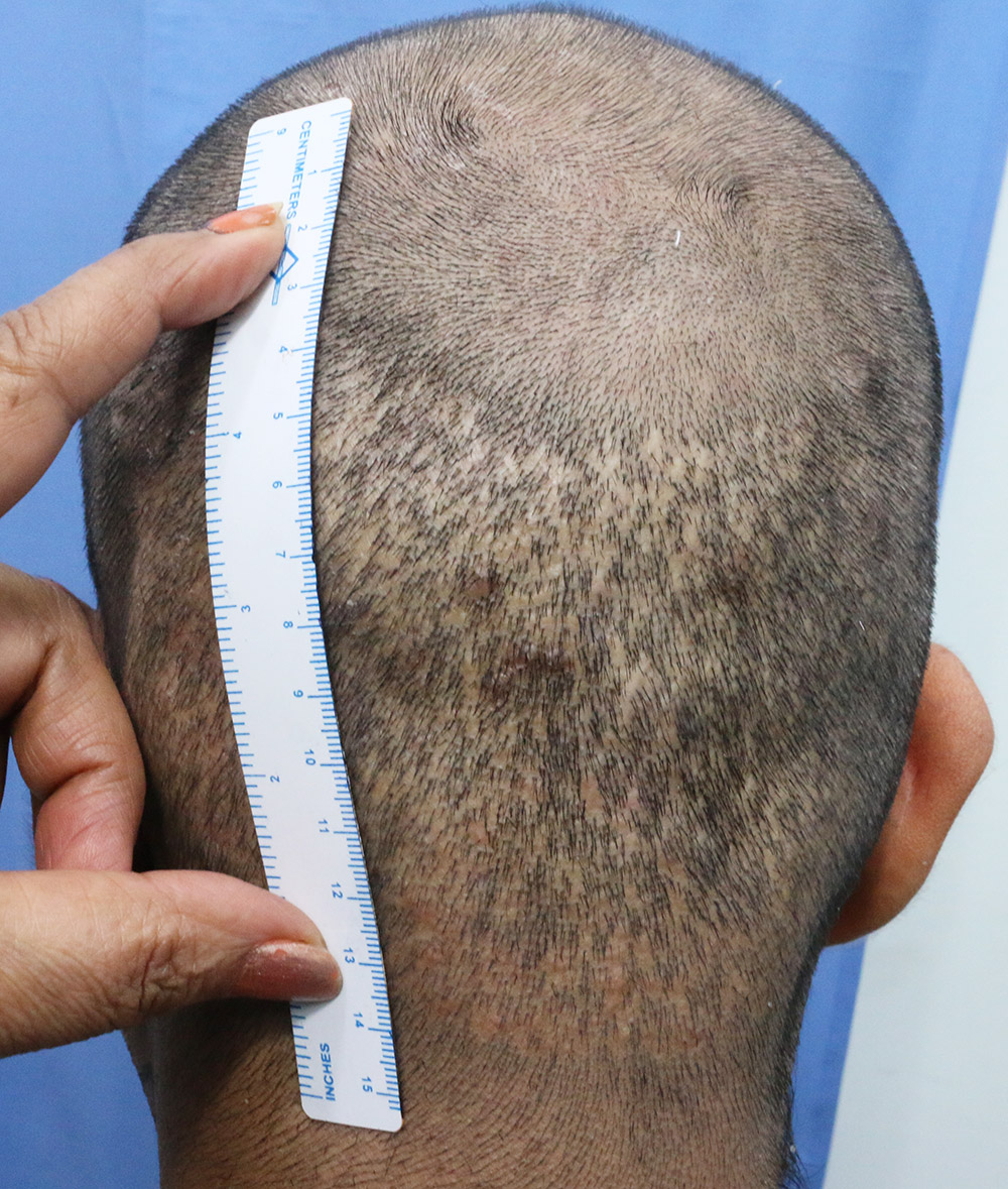 Fue hair transplant result by famous chain clinic Hair Transplant