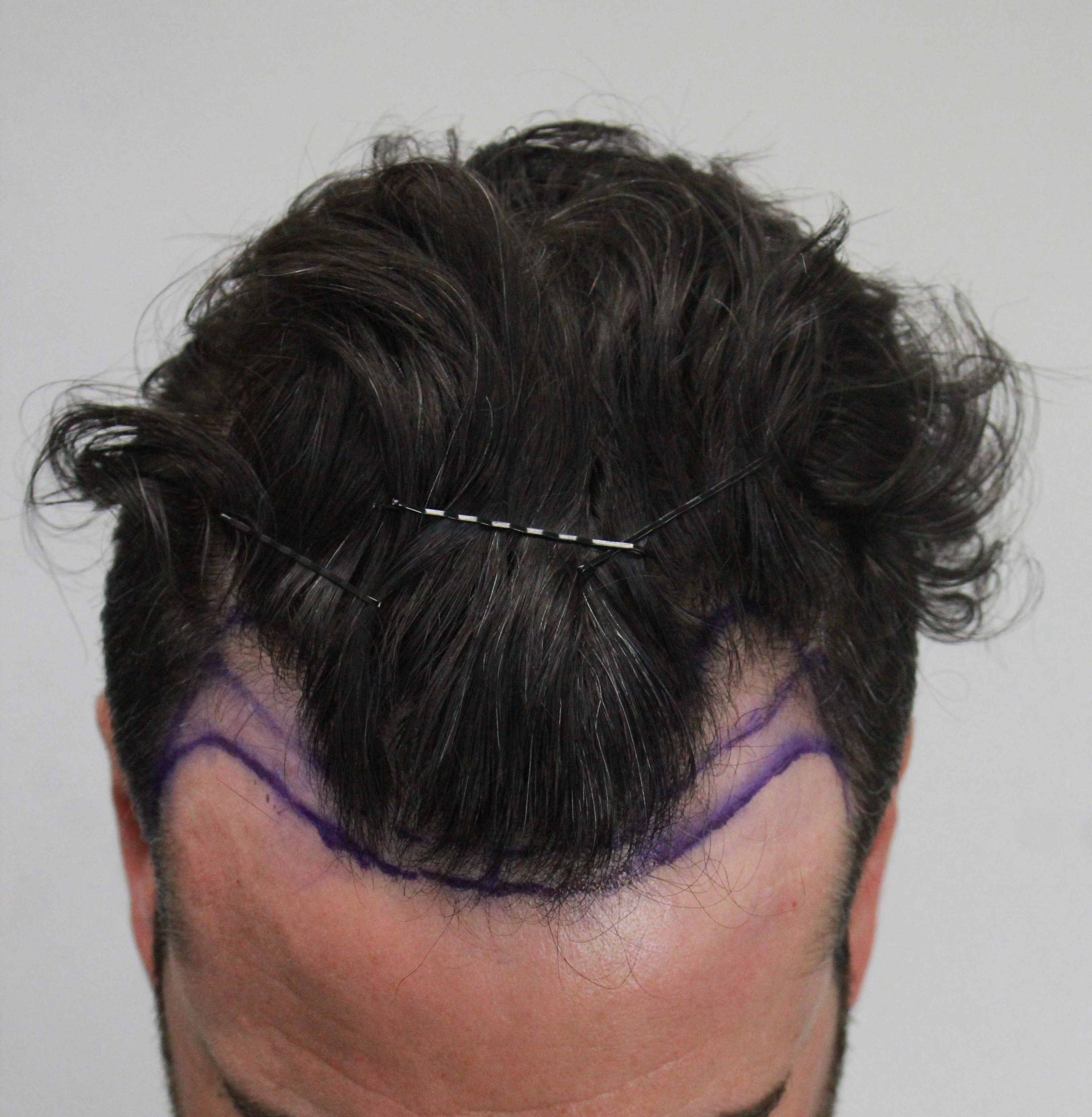 Rahal FUE Norwood 2 Hair Transplant HairSite Hair Restoration Forum
