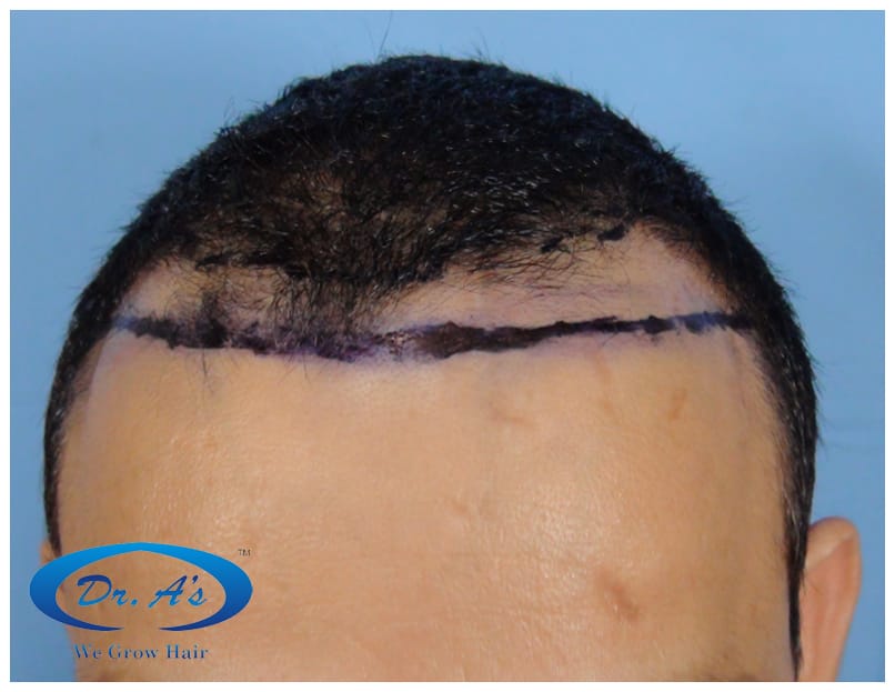 Do transplanted hair stop growing after certain years Do transplanted hair stop growing after certain years