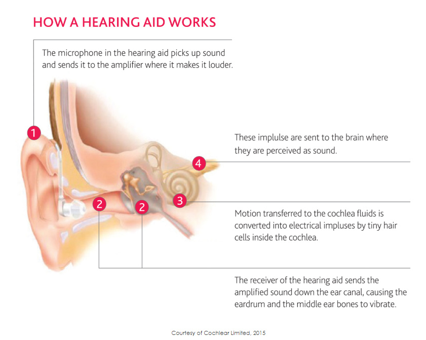 Proper orientation of Signia Click Sleeve when inserting hearing aid