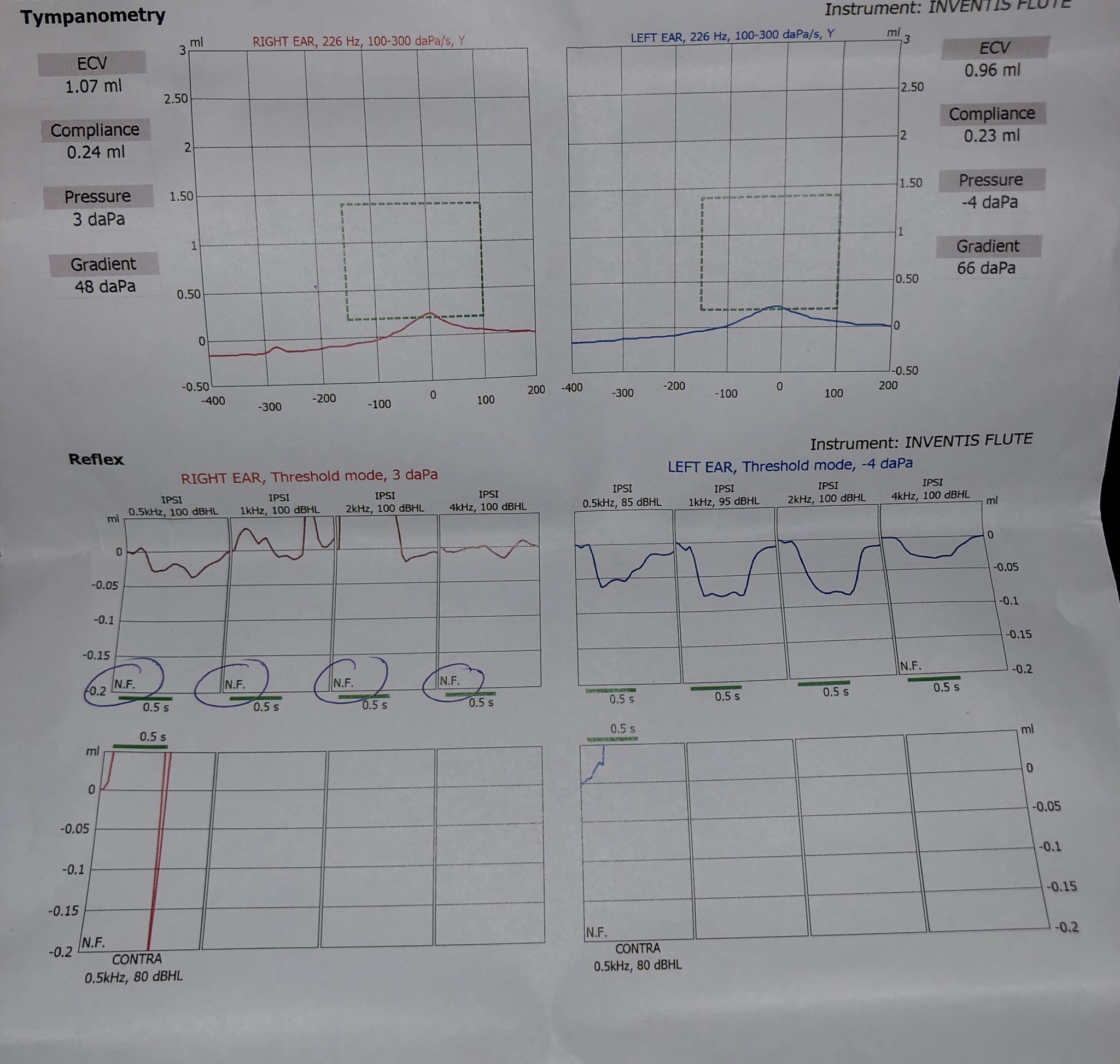Otosclerosis Tympanogram