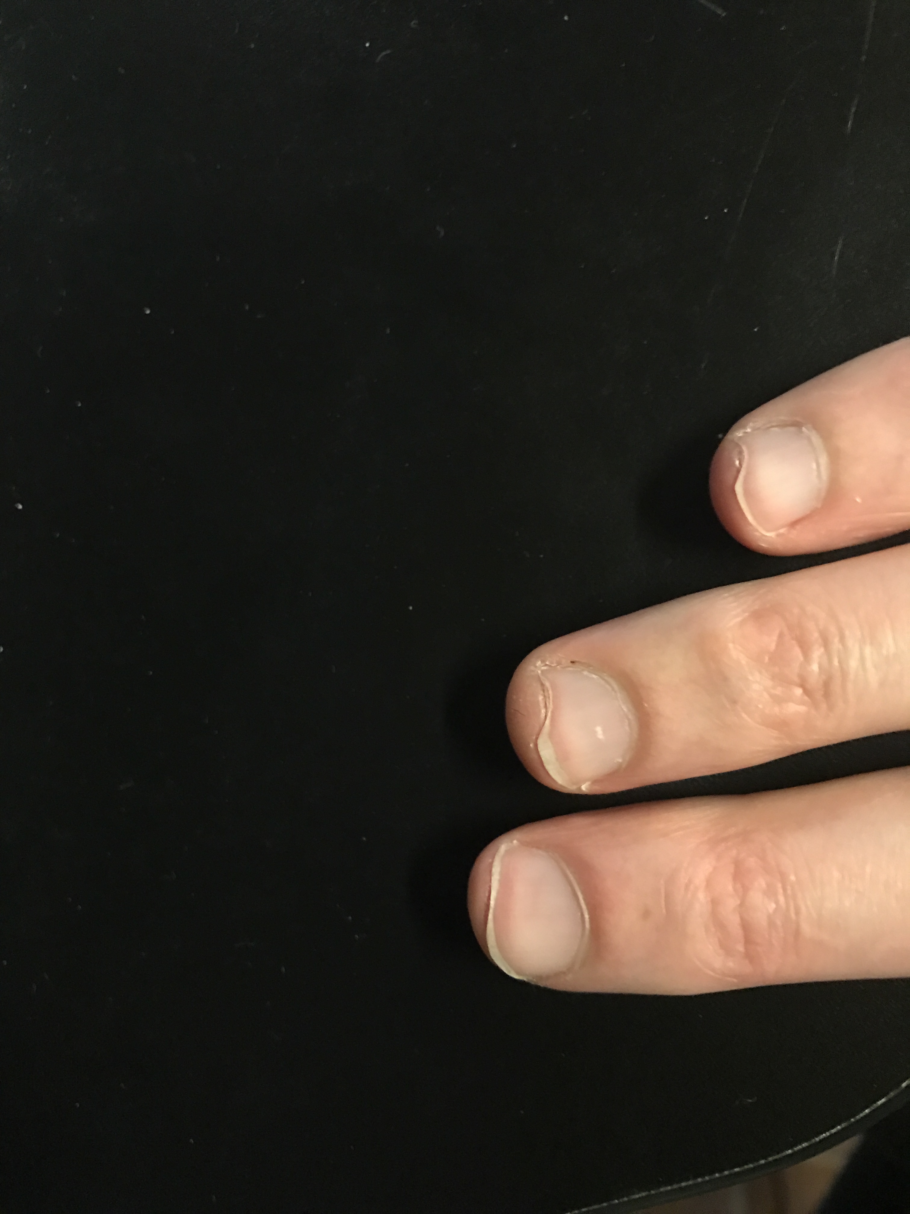 Hybrid picking nails problem Playing Technique The Cracking the