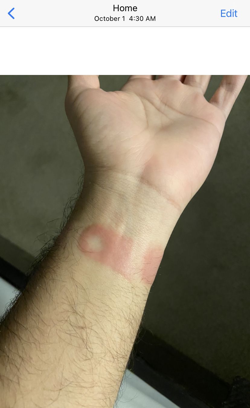 My Apple Watch Series 6 Band burned me? MacRumors Forums