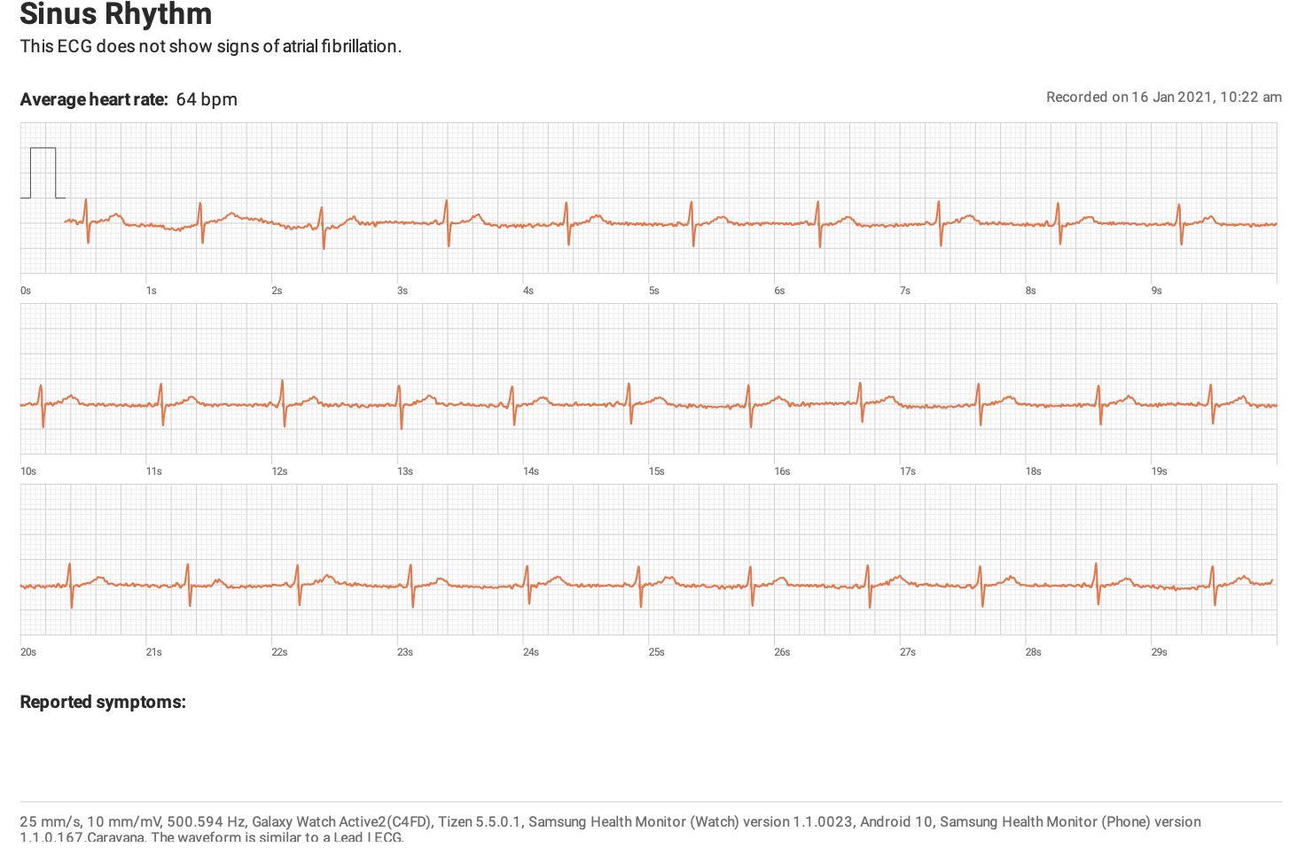 ECG graph from Samsung galaxy active 2 is less cleaner than apple watch