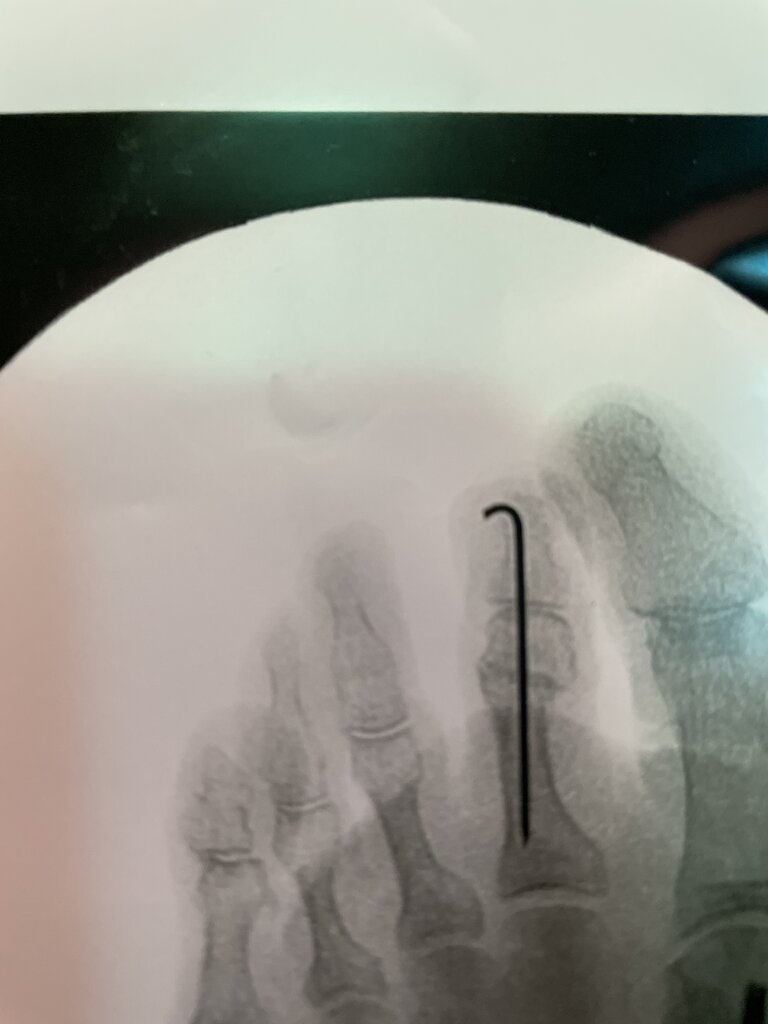 Hammertoe Implants Student Doctor Network