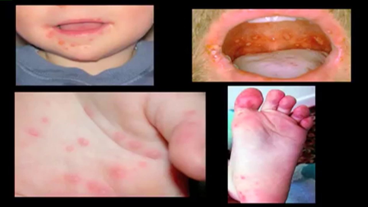 STLMoms Hand, Foot & Mouth Disease FOX 2