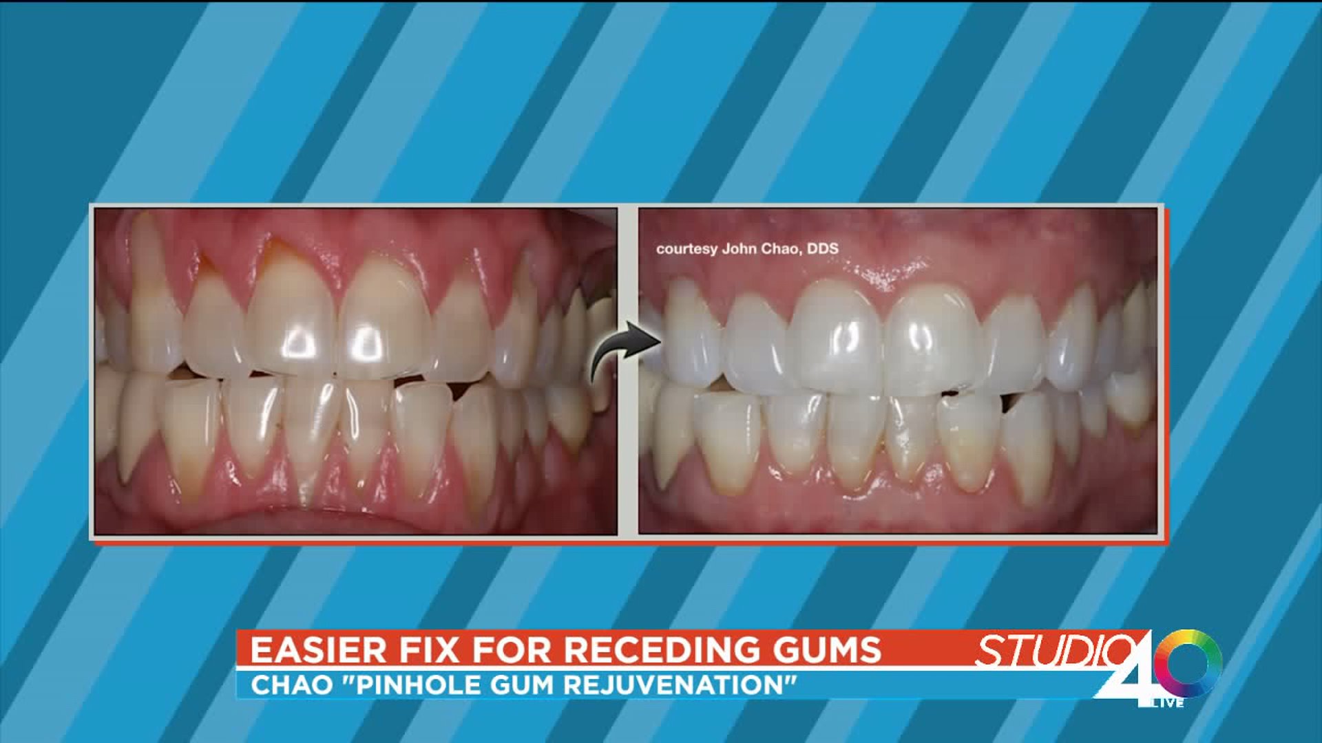 Easier Fix for Receding Gums FOX40