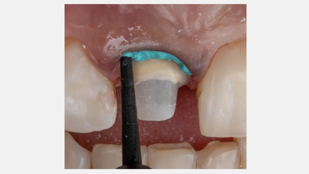 VOCO Retraction Paste ein Muss für jede Praxis Fragpip