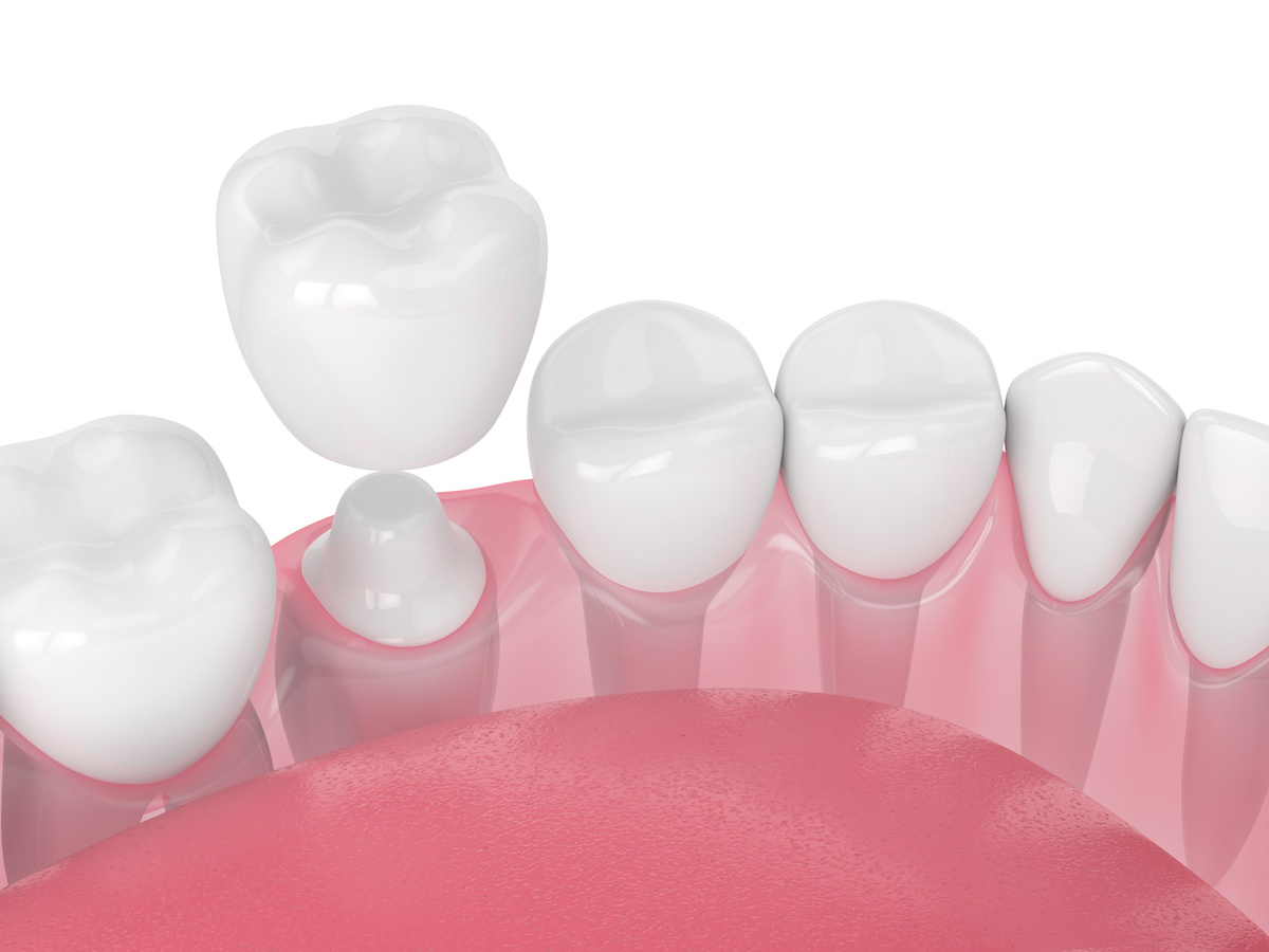 Dental Crowns Vancouver Dental Bridges Vancouver