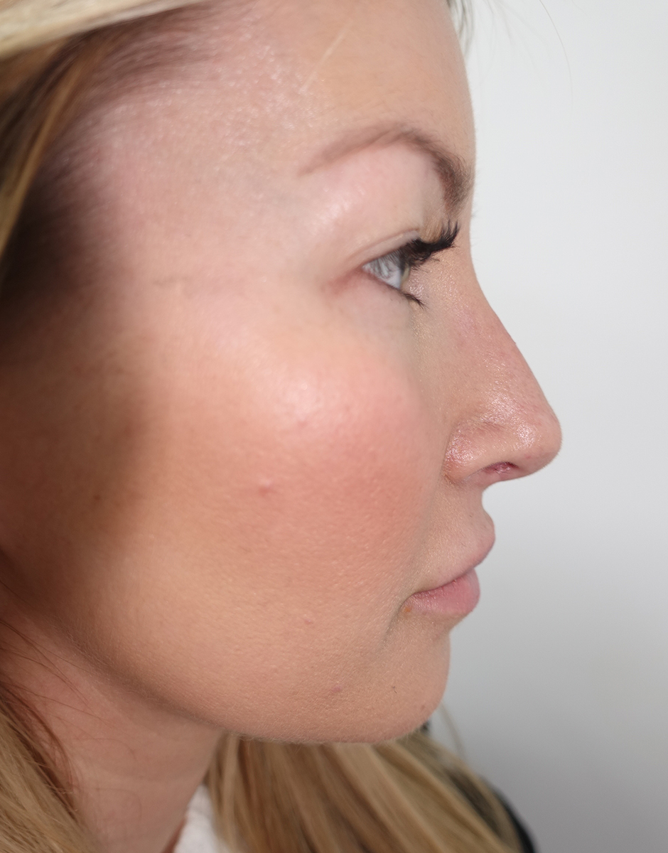 Rhinoplasty clinic in Manchester Frati Cosmetic Surgery