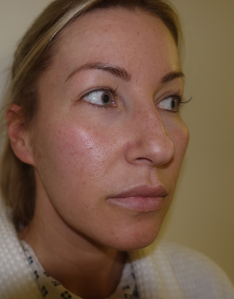 Rhinoplasty before and after Rhinoplasty in Manchester and London