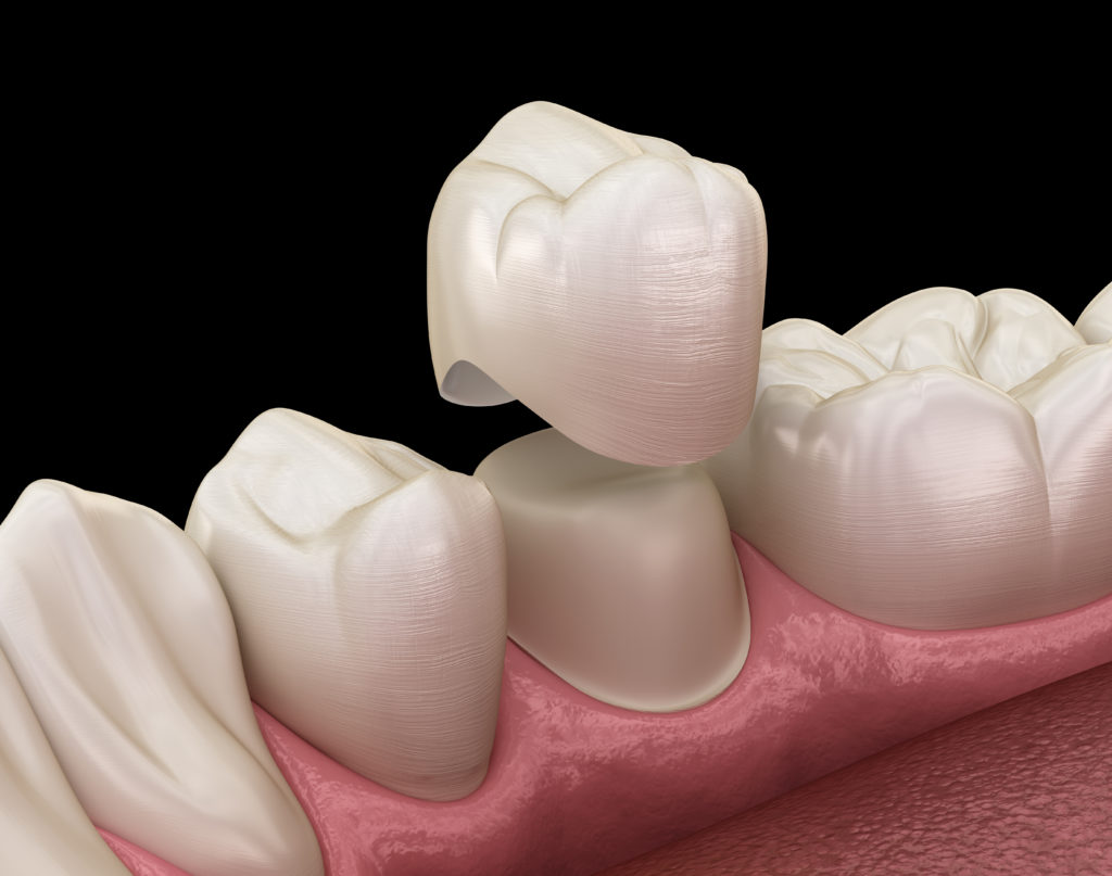 Porcelain Crowns and Bridges Fred Dahm Dentistry
