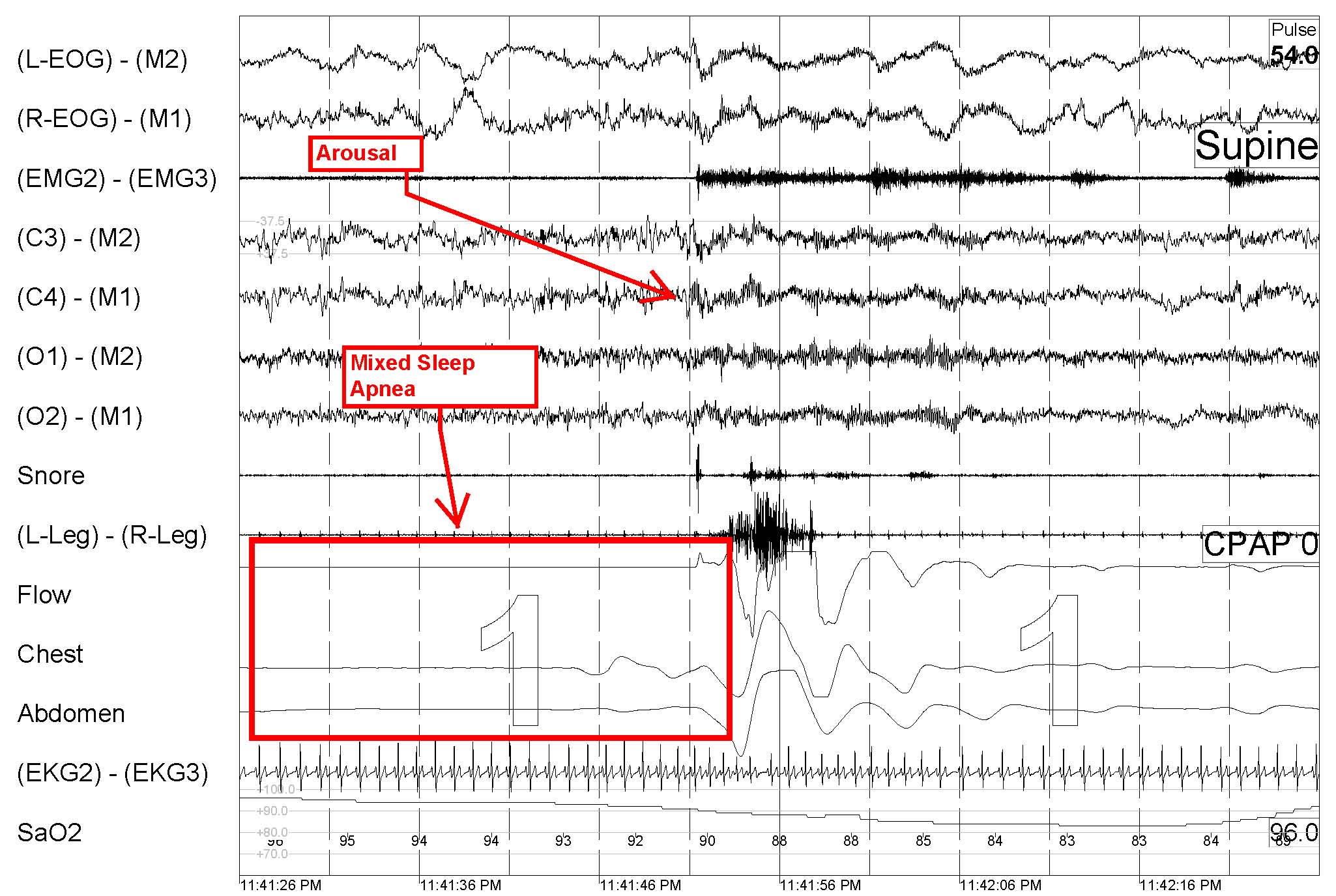 Eeg sleep study qleroservice