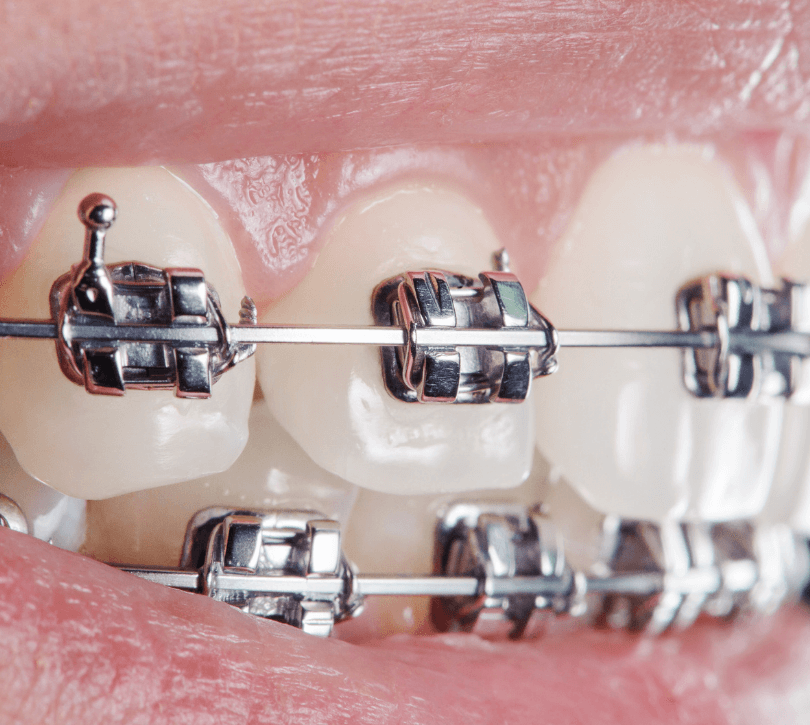 Why is orthodontics so essential for dental health? FRESH Dental NC