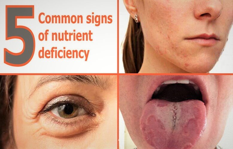 5 Clues Of Nutrient Deficiencies That Are Obviously Shown On Your Face