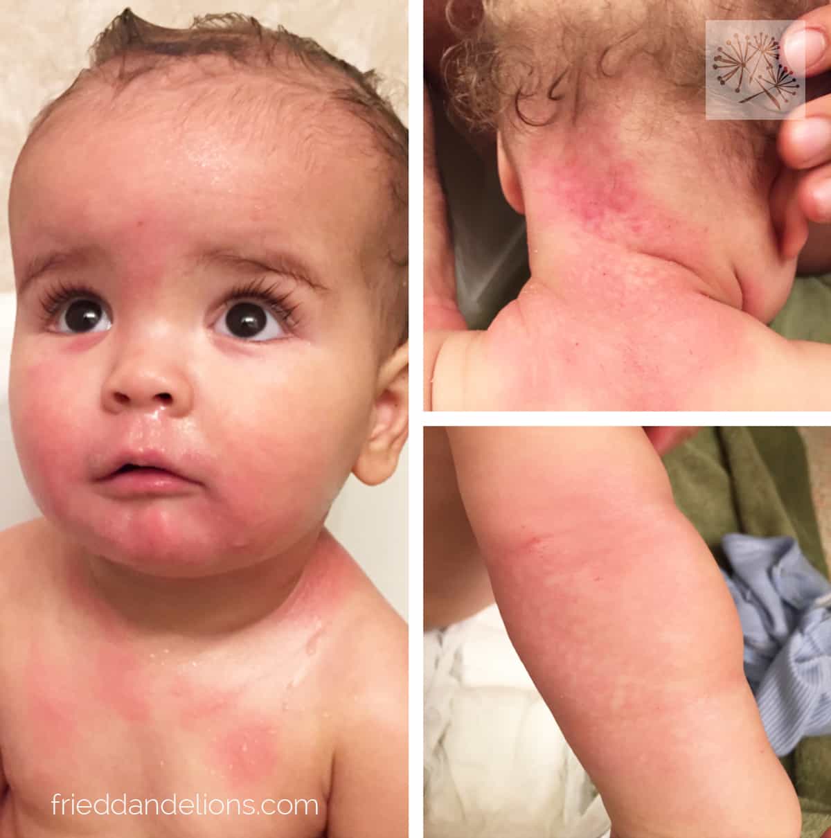 The Rabbit Hole of Food Allergies—Down We Go Fried Dandelions