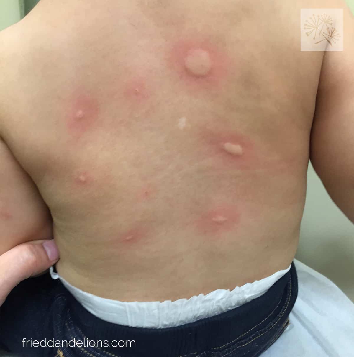 What I Want You to Know About Food Allergies — Fried Dandelions — Plant