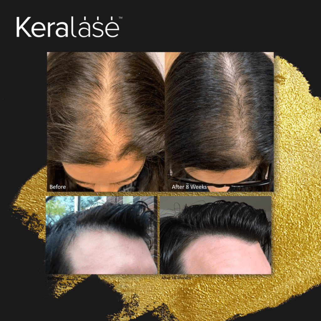 Why KeraLase is Better Than PRP for Hair Restoration