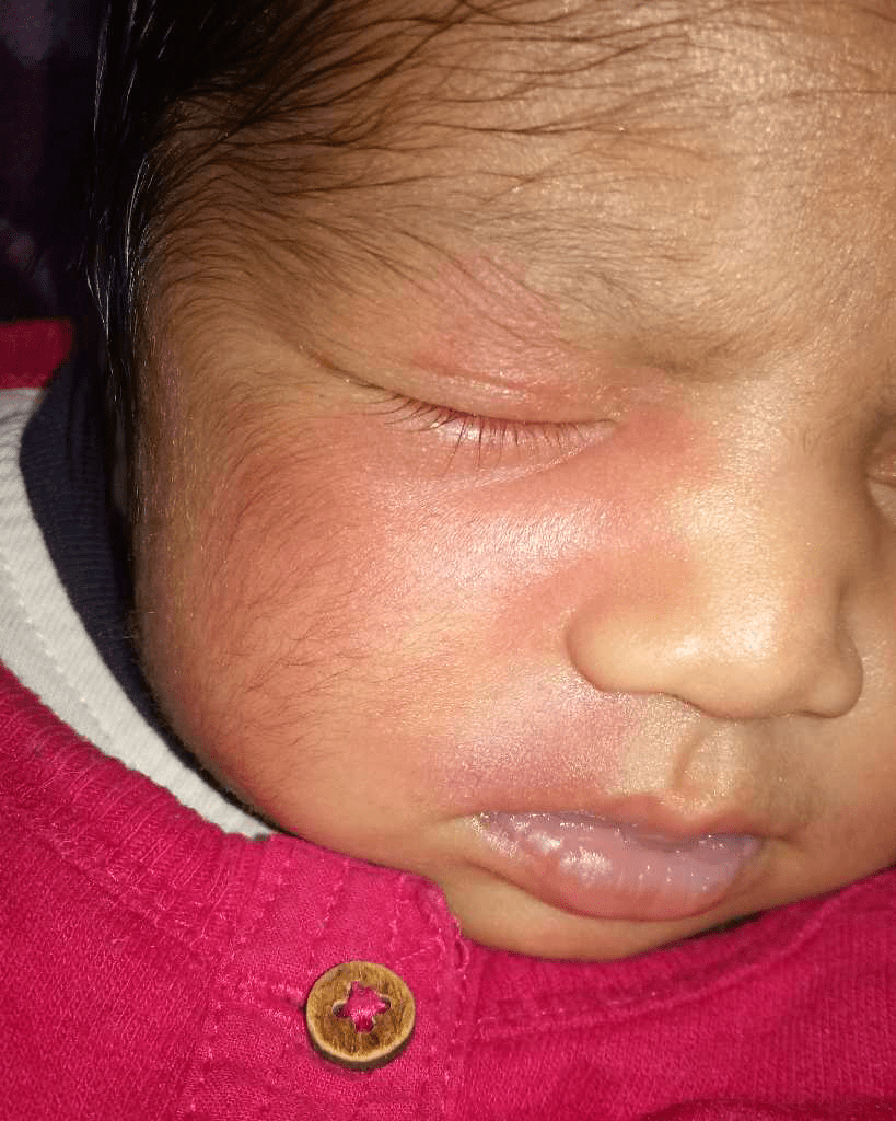 AskTheExpert Hello Doctor, my 6 months son has red spot like mark on his right side of the nose