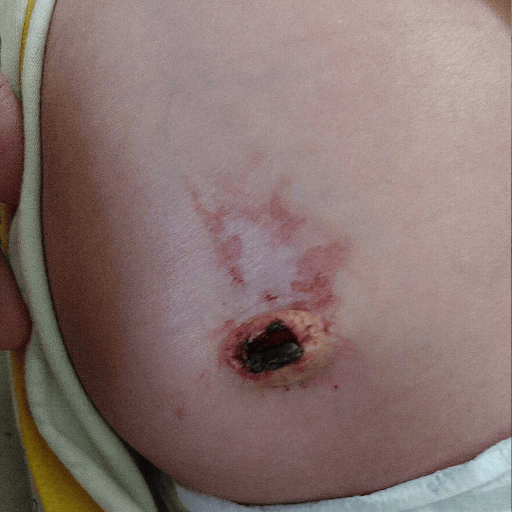 my baby is 20 days old , there is small drop bleeding from his belly