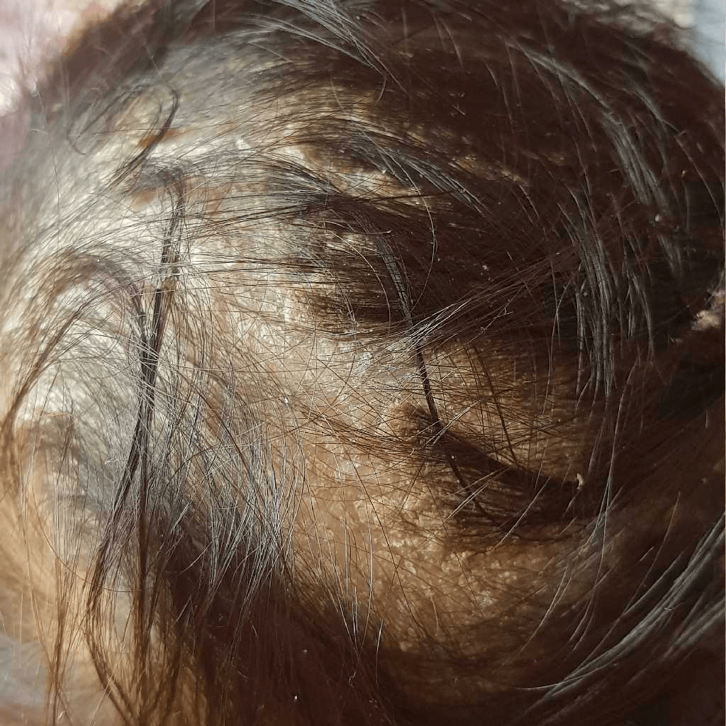 My Baby's Scalp Is Crusting And White Or Yellow Scales Are Seen Which Are Resulting In Hair Loss. Some Bald Patches Are Generated Due To This. Is This Normal? Will This Go