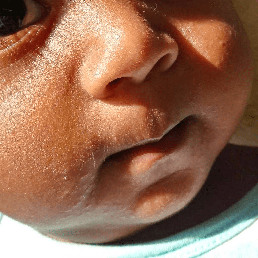 My 9month baby has some skin reaction all over his face.Picture