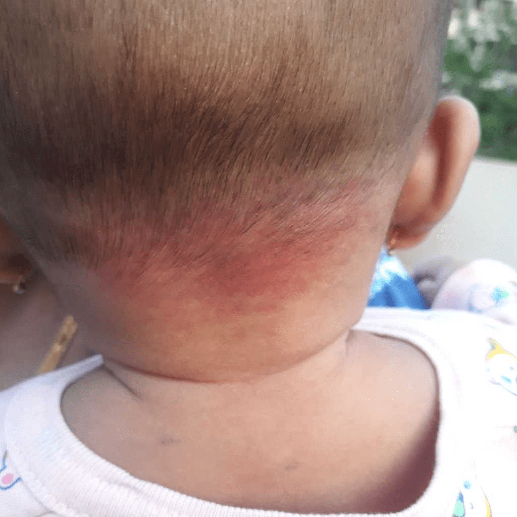 summercare Our baby boy is 4 months old. his skin on head